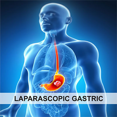 Laparascopic Gastric